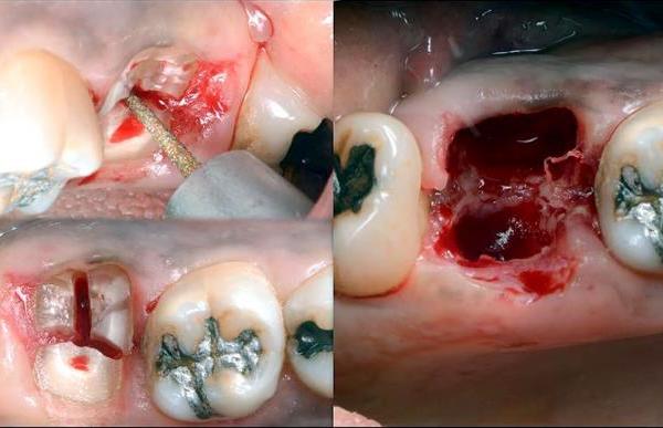  Аккуратное с минимальной травмой кости удаление зуба
