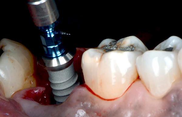  Установка имплантата в лунку после удаления зуба