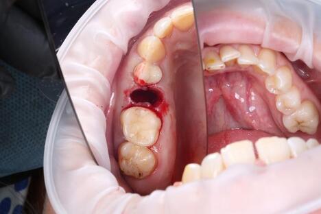Лунка после удаления зуба