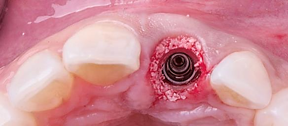 Немедленная имплантация зуба