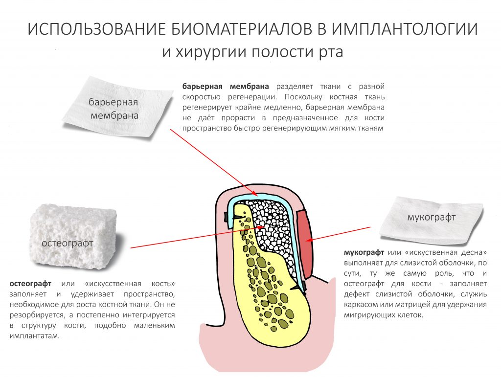 Использование биоматериалов в остеопластике