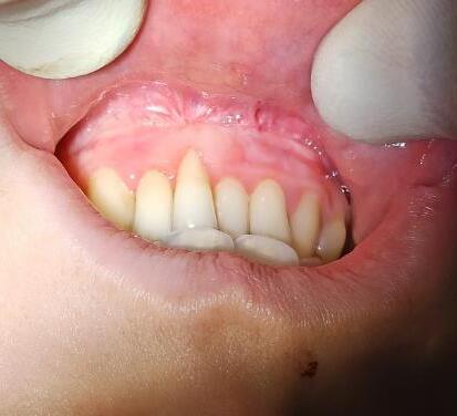 Аномалии положения зубов