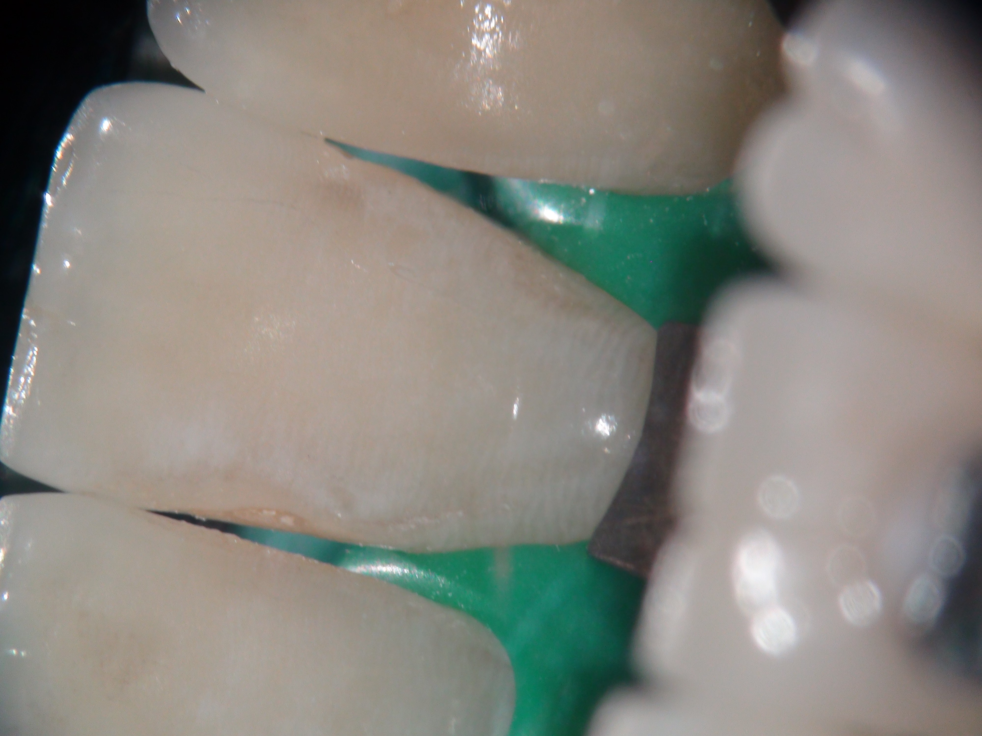 Зуб до лечения кариеса