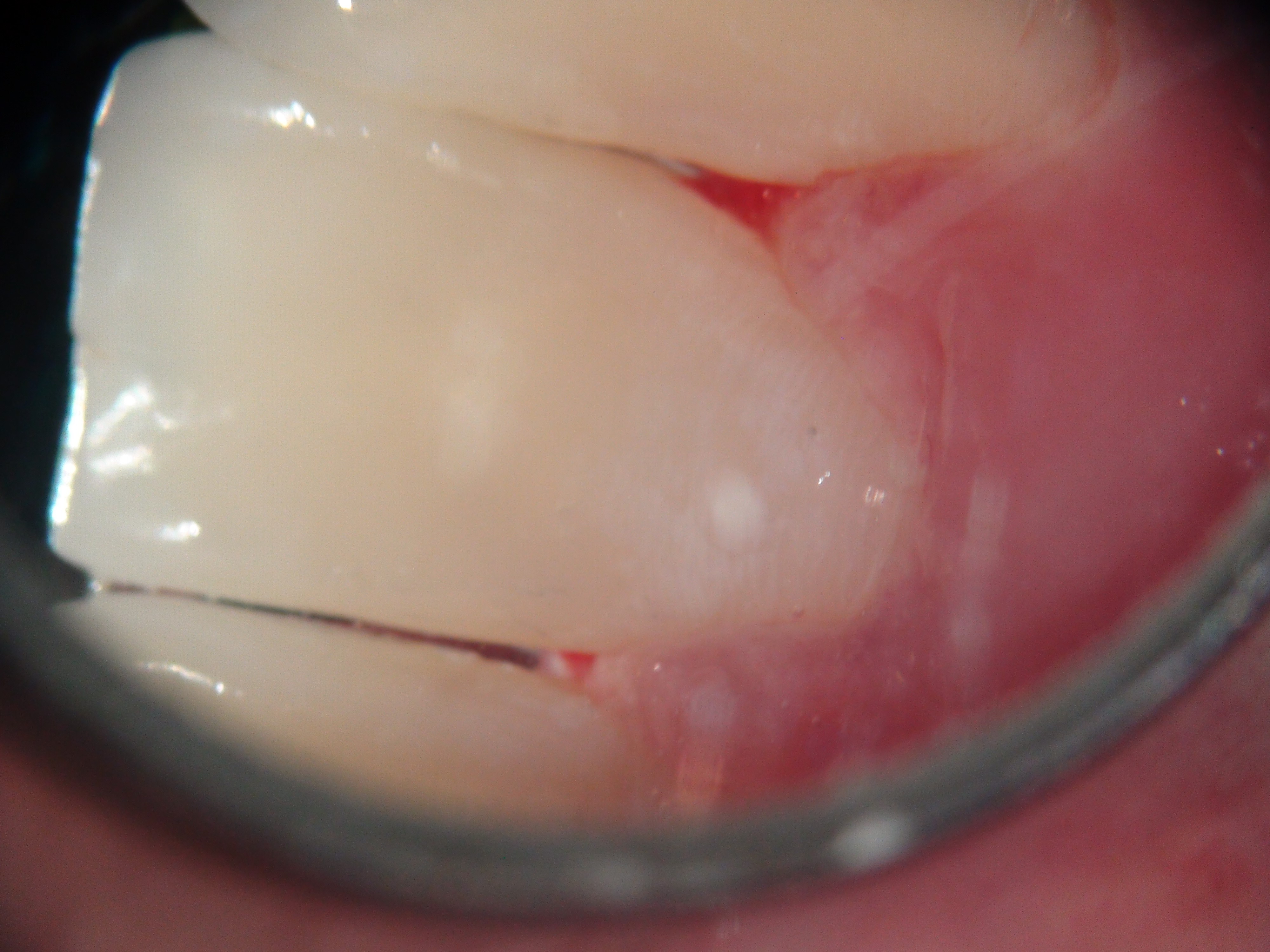 Зуб после лечения кариеса