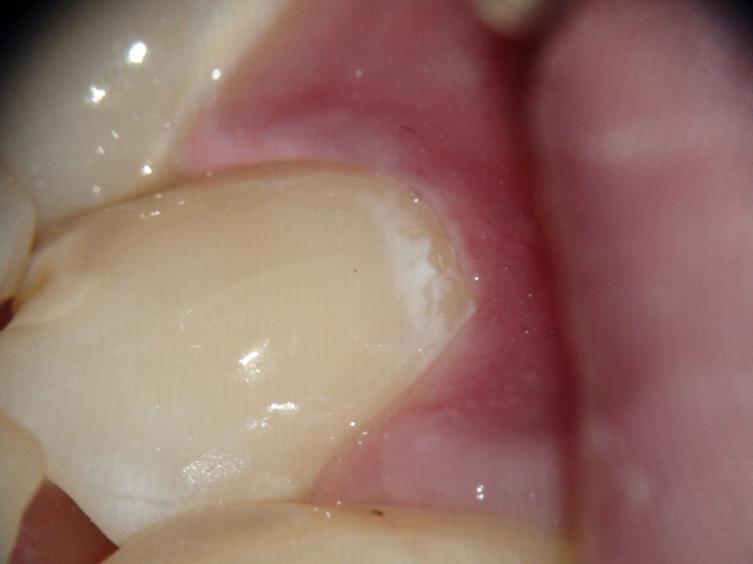 Зуб после лечения кариеса
