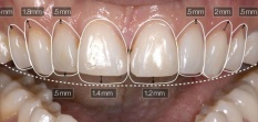 Хирургическое удлинение коронок зубов (гингивэктомия)