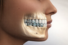 Ортодонтическая коррекция с применением аппарата Motion 3D