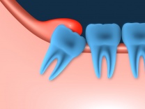 Раскрытие коронковой части ретинированных зубов для ортодонтии