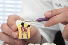 Лечение пульпита