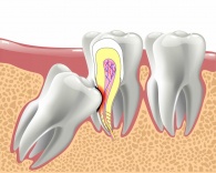 Удаление ретинированных зубов, зубов мудрости (и их зачатков)