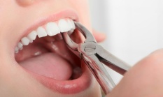 Удаление постоянных зубов