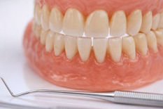 Пластика преддверия рта (вестибулопластика)