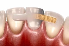 Шинирование зубов при заболеваниях пародонта