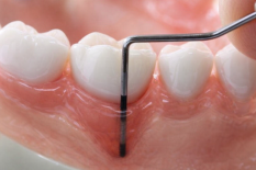 Закрытый кюретаж