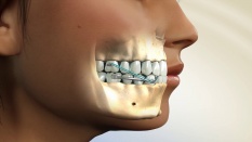 Ортодонтическая коррекция с применением аппарата Motion 3D