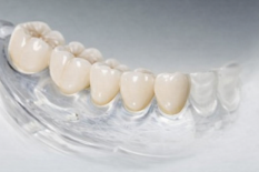 Металлокерамические коронки