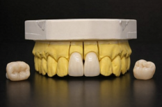 Цельнокерамические коронки