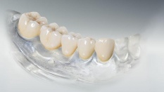 Металлокерамические протезы зубов