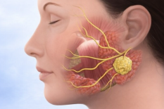 Удаление кист слюнных желез