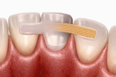 Шинирование зубов при заболеваниях пародонта