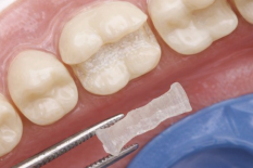 Микропротезирование