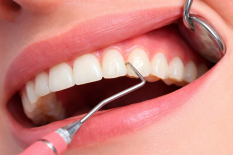 Операции по устранению рецессий