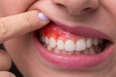 Удаление костных экзостозов, торусов