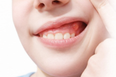 Удаление новообразований в полости рта