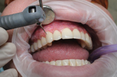 Лечение десен аппаратом Vector