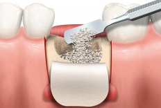 Консервация лунки зуба после удаления