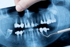 Рентгенограмма (радиовизиография)