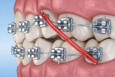 Лечение с опорой на микроимпланты