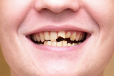 Лечение травмы зубов