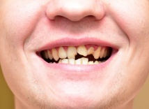 Лечение травмы зубов