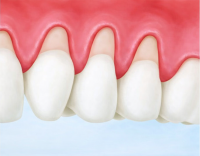 Гингивопластика