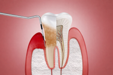Лечение периодонтита