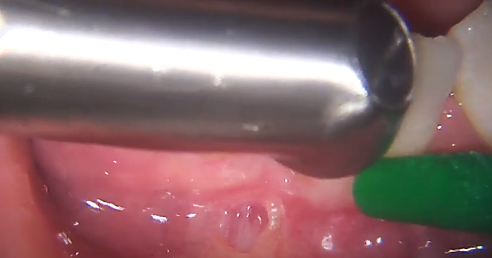 Коррекция уздечки нижней губы с помощью лазера