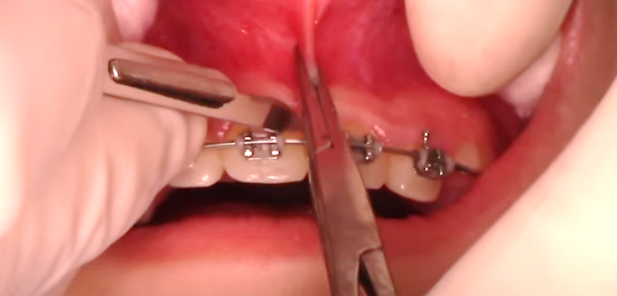 Коррекция уздечки верхней губы с использованием скальпеля
