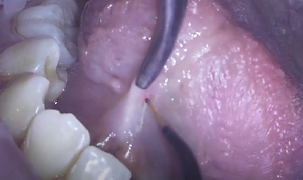 Коррекция уздечки верхней губы диодным лазером