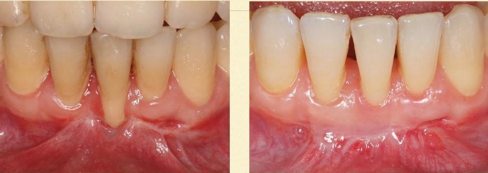 после открытой вестибулопластики